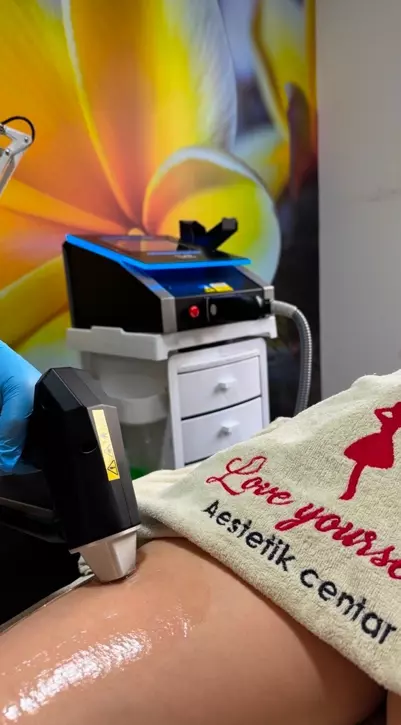 LaserskaepilacijaSkopje5 LaserskaepilacijaSkopje5